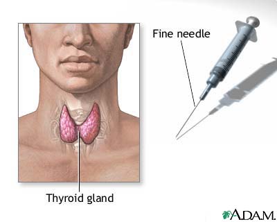 Get new treatments for thyroid cancer