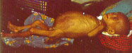 A Malnourished Infant