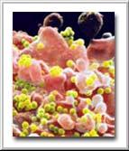 Scanning Electron Micrograph (SEM) of the surface of a T-Lymphocyte (pink) infected with HIV